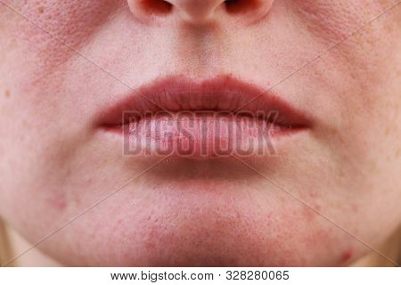 Expanded Pores, Acne, Comedones, Black Spots. Lips Close Up. Problem Skin Girl