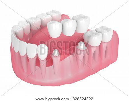 3D Render Of Jaw With Dental Bridge