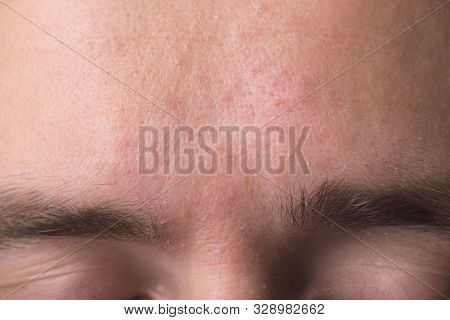 Weeping Eczema In The Stage Of Exudation. Closeup Of Forehead Area With Eczema Rash Clinic