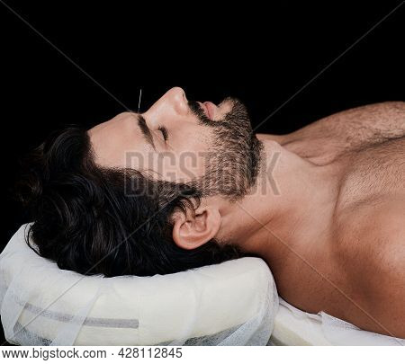 Male Patient Lies During Acupuncture Procedure In A Wellness Center With Acupuncture Needle In His F