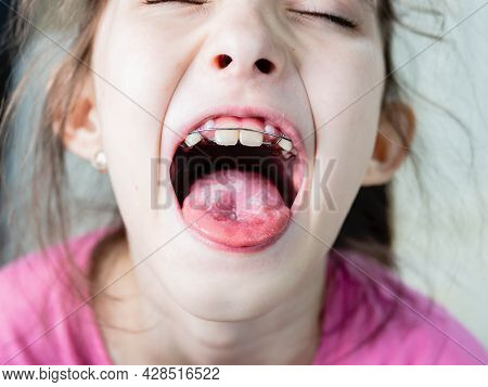 A Child At The Doctor. The Doctor Examines The Throat Of A Child.