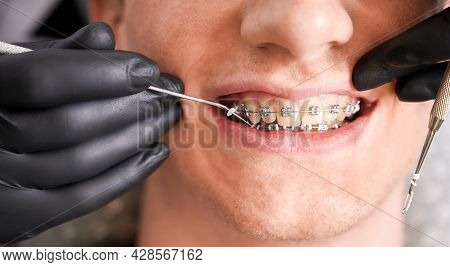 Close Up Of Dentist Hands In Sterile Gloves Putting Elastic Rubber Band On Patient Brackets. Man Wit