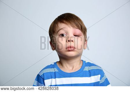 A Boy With Swollen Eye From Insect Bite. Quincke Edema. Portrait Of Caucasian Appearance Child Looki