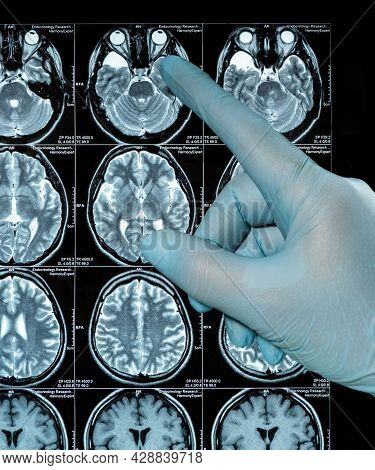 Mri Scan Image Of A Human Brain Showing All Main Multiple Sclerosis Hand In Bliue Glove Points