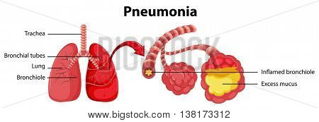 Diagram showing lung with pneumonia illustration