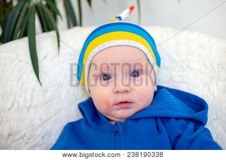 Allergies, Atopic Dermatitis On The Face Of A Baby