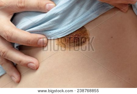 Ringworm On The Human Skin As A Background .