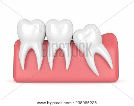 3d Render Of Teeth With Wisdom Mesial Impaction Over White Background. Concept Of Different Types Of