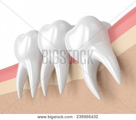 3d Render Of Teeth With Wisdom Mesial Impaction. Concept Of Different Types Of Wisdom Teeth Impactio