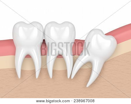 3d Render Of Teeth With Wisdom Distal Impaction. Concept Of Different Types Of Wisdom Teeth Impactio
