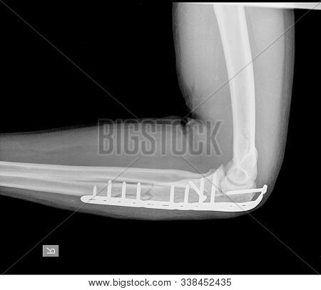 X-ray Elbow An Olecranon Fracture My Be Held Together With Plate And Screws.this Is Called A Tension