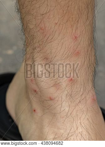 Allergic Reactions To Tick Bites