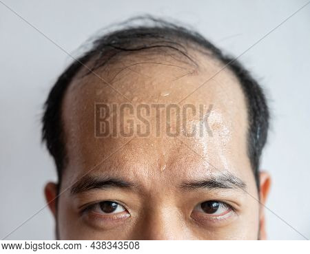 Closed Portrait Of Asian Man Forehead With Sweating On His Forehead Cause Of Hot Weather Or Etc.