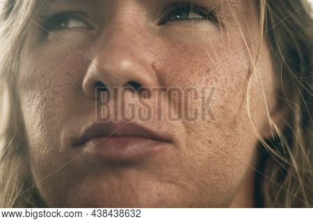 Close-up Side Portrait Young Woman Real Problem Face Skin Cheek Acne Icepick Scar Big Open Hole Pore