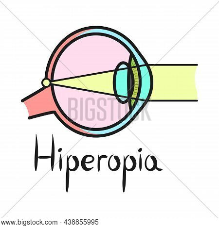 Vector Illustration Of Hyperopia And Eyeball Sign. Web Element Of Hyperopia And Eye Vector Icon For 