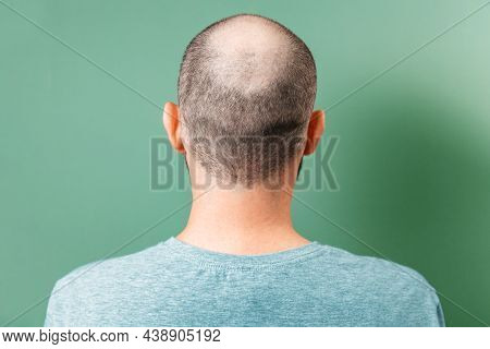 Back View Of Baldness Man. Rear View. Green Background. Copy Space. The Concept Of Alopecia And Aest