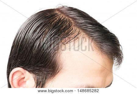 Closeup young man serious hair loss problem for hair loss concept