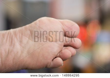 Woman foot after remove and scrub callus dry skin
