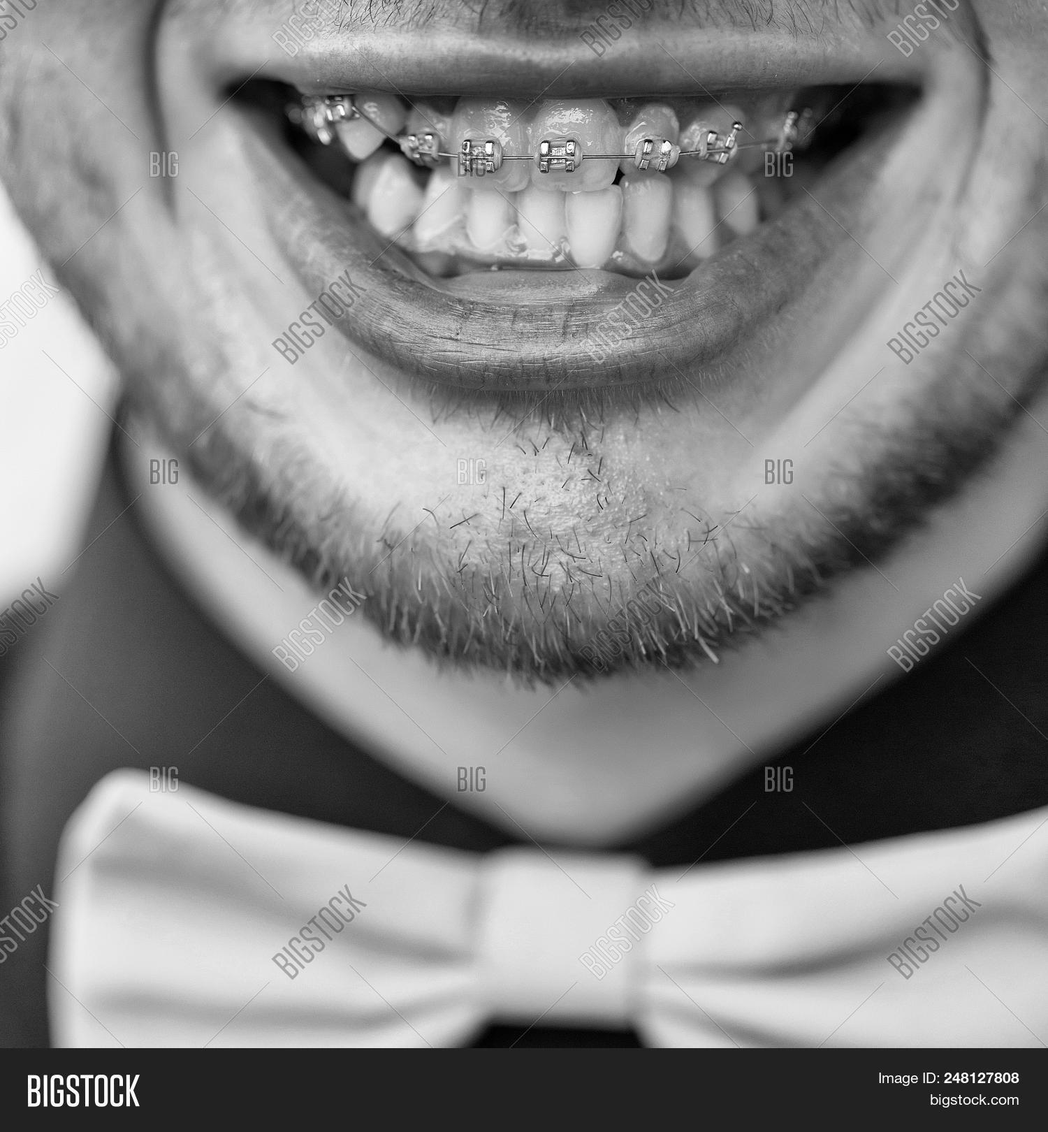 Braces Dentistry. Image & Photo (Free Trial) Bigstock