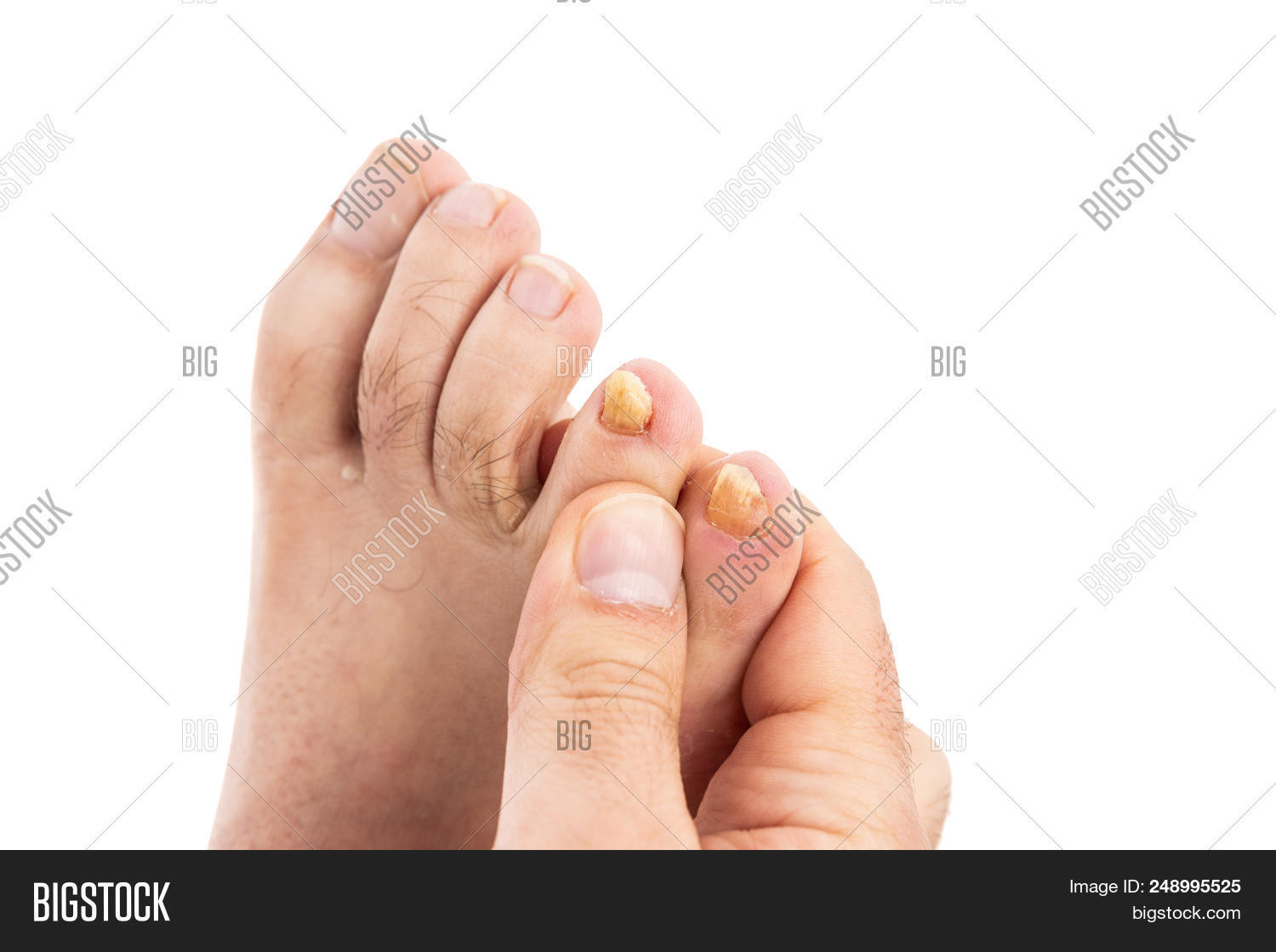 Ugly Male Toenails Image & Photo (Free Trial) Bigstock