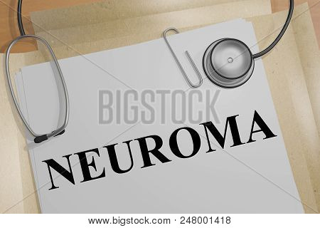 3d Illustration Of Neuroma Title On A Medical Document