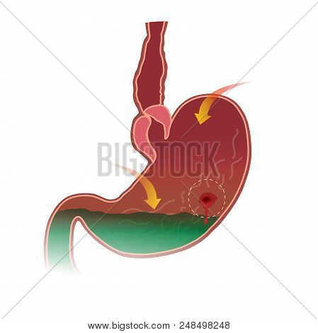 Stomach Peptic Ulcer. Anatomy Body. Health Care Illustration.