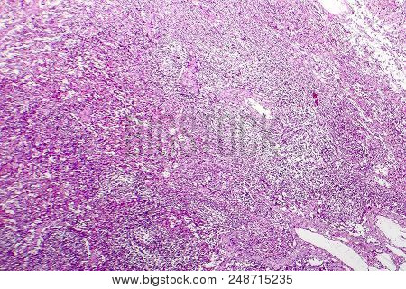 Hemorrhagic Lymphadenitits, Lymph Node Inflammation And Hemorrhage, Light Micrograph, Photo Under Mi