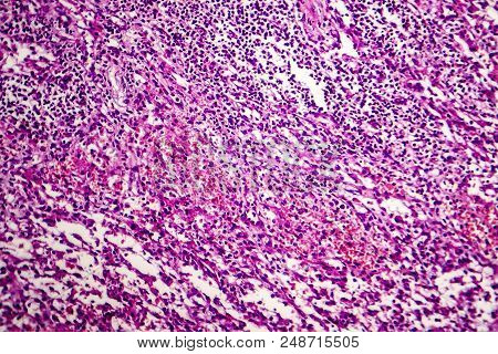 Hemorrhagic Lymphadenitits, Lymph Node Inflammation And Hemorrhage, Light Micrograph, Photo Under Mi