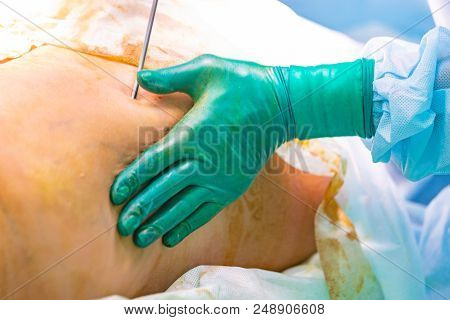 Cosmetic Liposuction Surgery In Operating Room Setting Showing Surgeon Hands And Cannula
