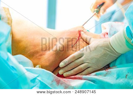 Cosmetic Liposuction Surgery In Operating Room Setting Showing Surgeon Hands And Cannula