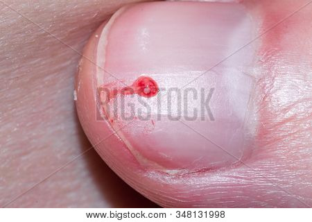 Squeezed Pimple With Blood On The Nail.