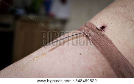 Lymphatic Drainage Duct In The Wound. Postoperative Removal Of Lymph To Avoid Edema. Lymphorrhea