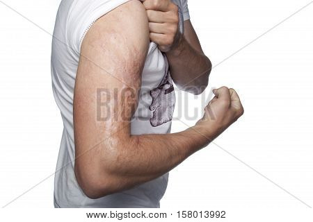 Scar On His Forearm, Scalding With Boiling Water