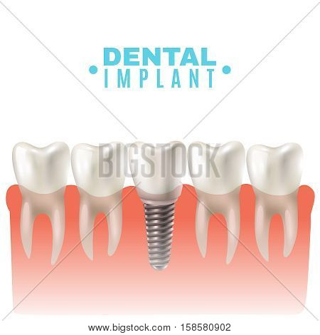 Dental implant model closeup cut away side view educative medical poster vector illustration