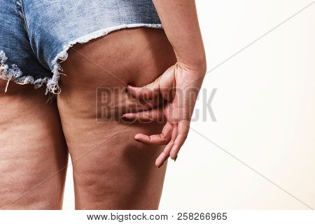 Woman Legs Thighs With Cellulite Skin Problem. Body Care, Overweight And Dieting Concept.