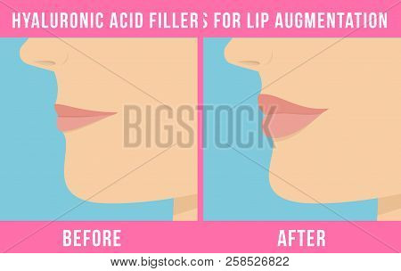Woman Makes Procedure Of Beauty Injection For Lip Augmentation. Lips Before And After Hyaluronic Aci