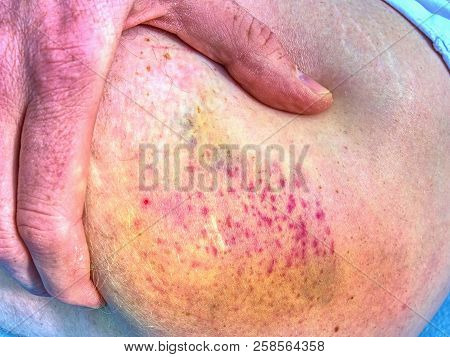 Bruised Wound Injury On Human Body. Patient Show Injured Body With Large Paintful Hematoma.