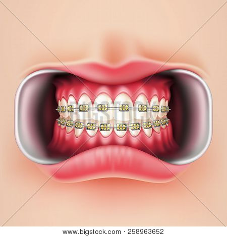 Vector Dental Braces, Oral Brakets System 3d