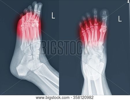 X-ray Foot And Ankle (ap,lat)showing Metatarsal Fractures On Red Point.metatarsal Fractures Are Amon