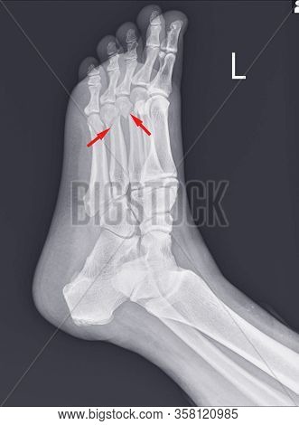 X-ray Foot And Ankle Showing Metatarsal Fractures On Red Arrow Point.metatarsal Fractures Are Among 