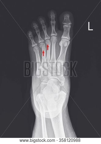 X-ray Foot And Ankle Showing Metatarsal Fractures On Red Arrow Point.metatarsal Fractures Are Among 
