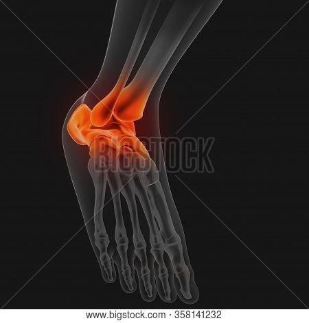 Joint Pain Can Be Caused By Injury Affecting Any Of The Ligaments, Bursae, Or Tendons Surrounding Th