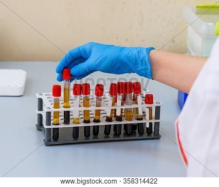 Hands Of Laboratory Assistant In Gloves Analyzing Blood Sample. Prevention. Pneumonia Diagnosing. Co