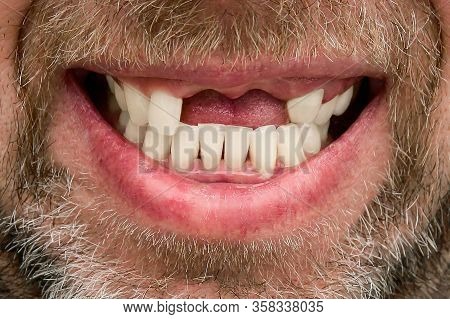 Smile Of A Bearded Man Without Upper Front Teeth, Gum Disease In Humans, Paradontosis, Close-up