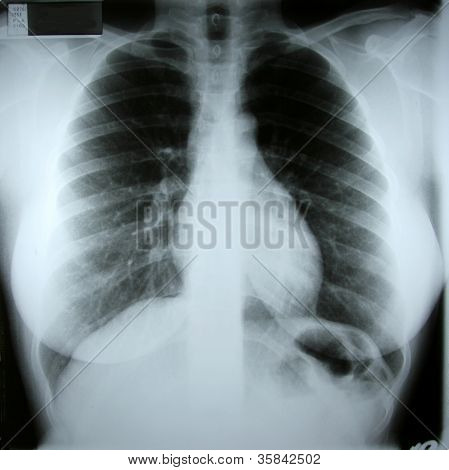 Torax Xray