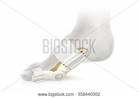 Hallux Valgus Orthopedic Medical Thumb Brace Isolated On White Background. Orthoses For Toes.