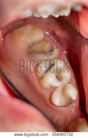Treatment Tooth Decay With Subsequent Filling With Photopolymer Material. Close-up, Macro