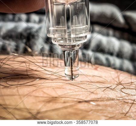 Antithrombotic Injection Into The Abdomen. Thrombosis Prevention
