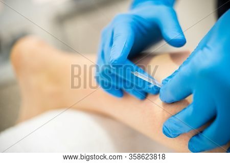 Hands Of Physiotherapist Doing A Dry Needling