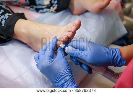 Podology Treatment. Podiatrist Treating Toenail Fungus. Doctor Removes Calluses, Corns And Treats In